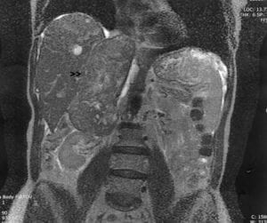 Leiomyosarcoma, pictured here, is a risk of power morcellation. 