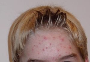 Acne is a common feature of puberty but can extend into adulthood.